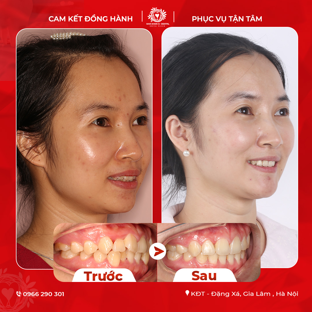 Khách hàng niềng răng tại Yên Viên - Gia Lâm