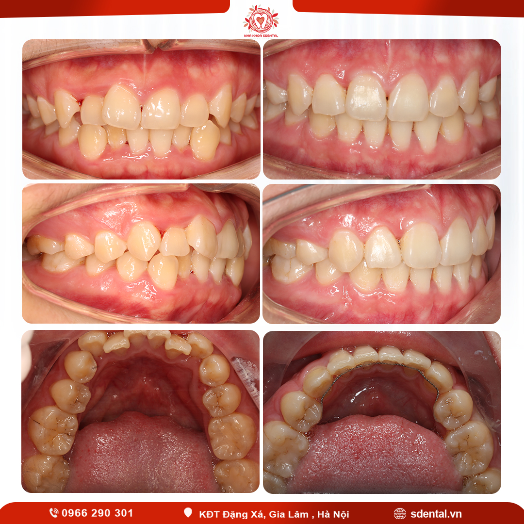 Các nha khoa niềng răng uy tín ở Yên Viên - Gia Lâm