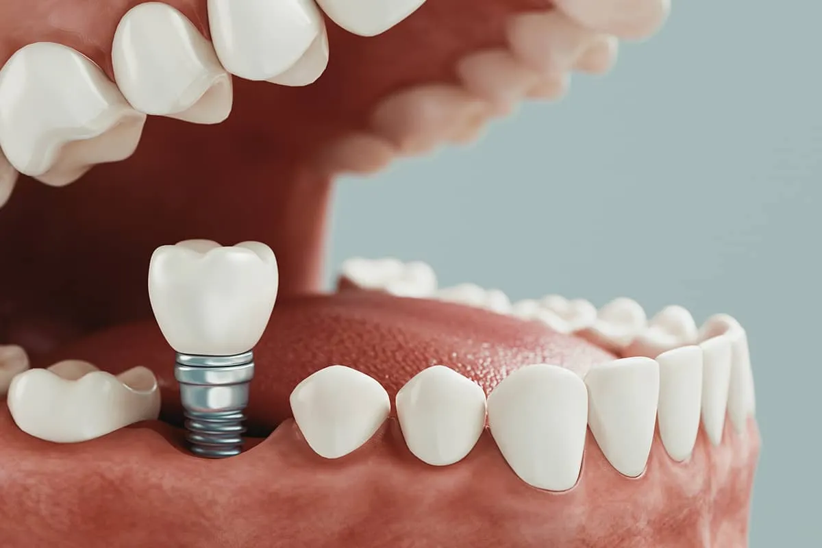 cay-ghep-implant-don-le