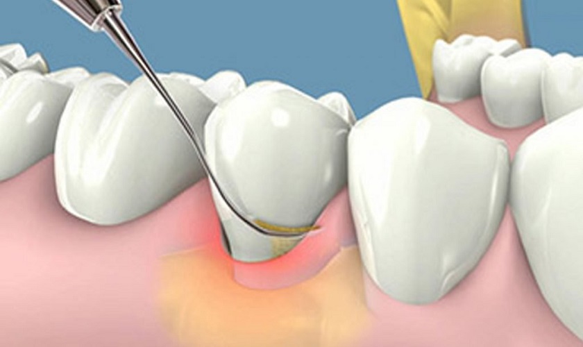 Chữa Tụt Lợi Chân Răng: Nguyên Nhân, Cách Điều Trị và Phòng Ngừa Hiệu Quả