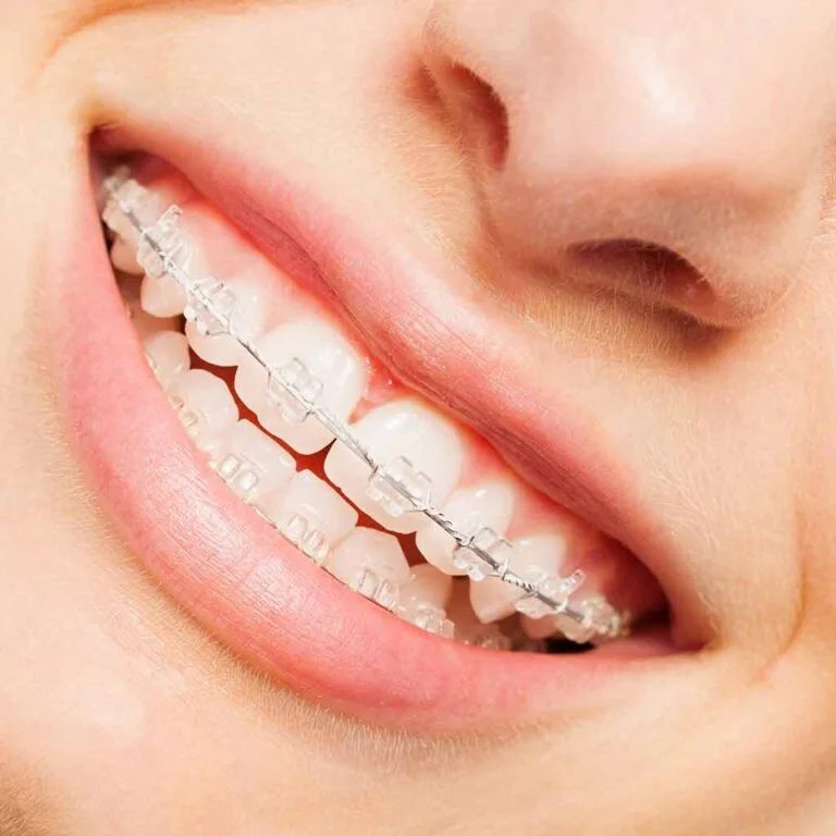 Niềng Răng Clear Aligner: Giải Pháp Chỉnh Nha Vô Hình, Hiệu Quả Cao