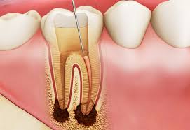 Viêm Tủy Răng: Nguyên Nhân, Điều Trị, và Cách Phòng Ngừa Hiệu Quả