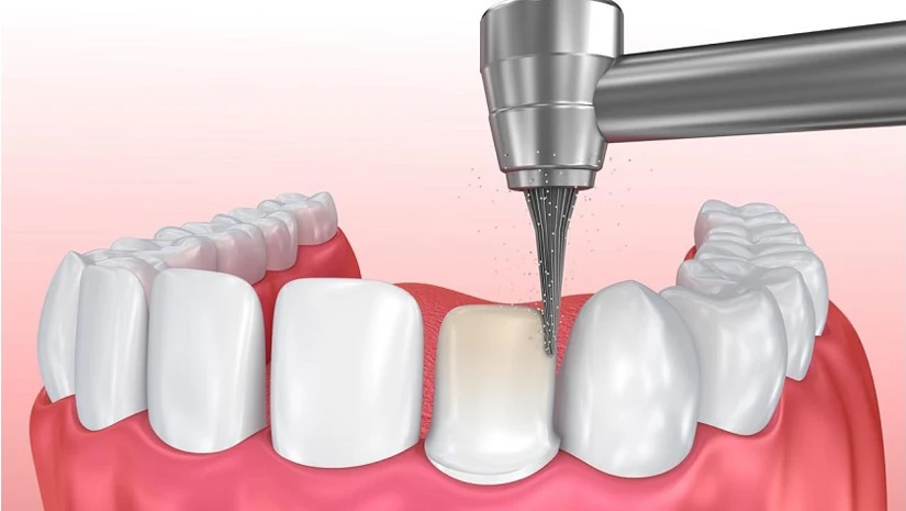 Mài Răng Sứ: Quy Trình, Có Đau Không, Ảnh Hưởng Gì và Lưu Ý