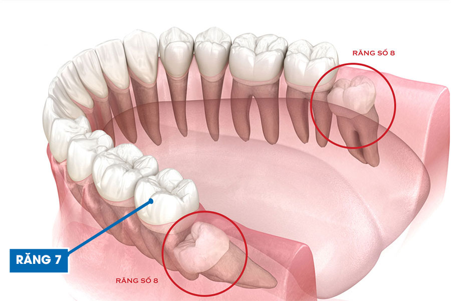 Nhổ Răng Số 7: Khi Nào Cần, Quy Trình, Biến Chứng, Chăm Sóc và Phục Hồi