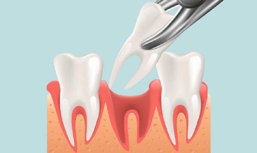 Nhổ Răng Số 8: Chỉ Định, Quy Trình, Biến Chứng và Hướng Dẫn Chăm Sóc