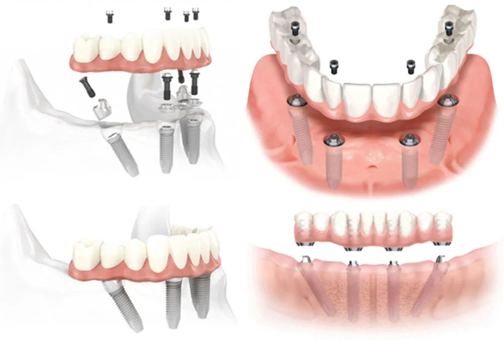 Cắm Implant All-on-4: Giải Pháp Phục Hình Răng Toàn Hàm Nhanh Chóng, Hiệu Quả, Thẩm Mỹ