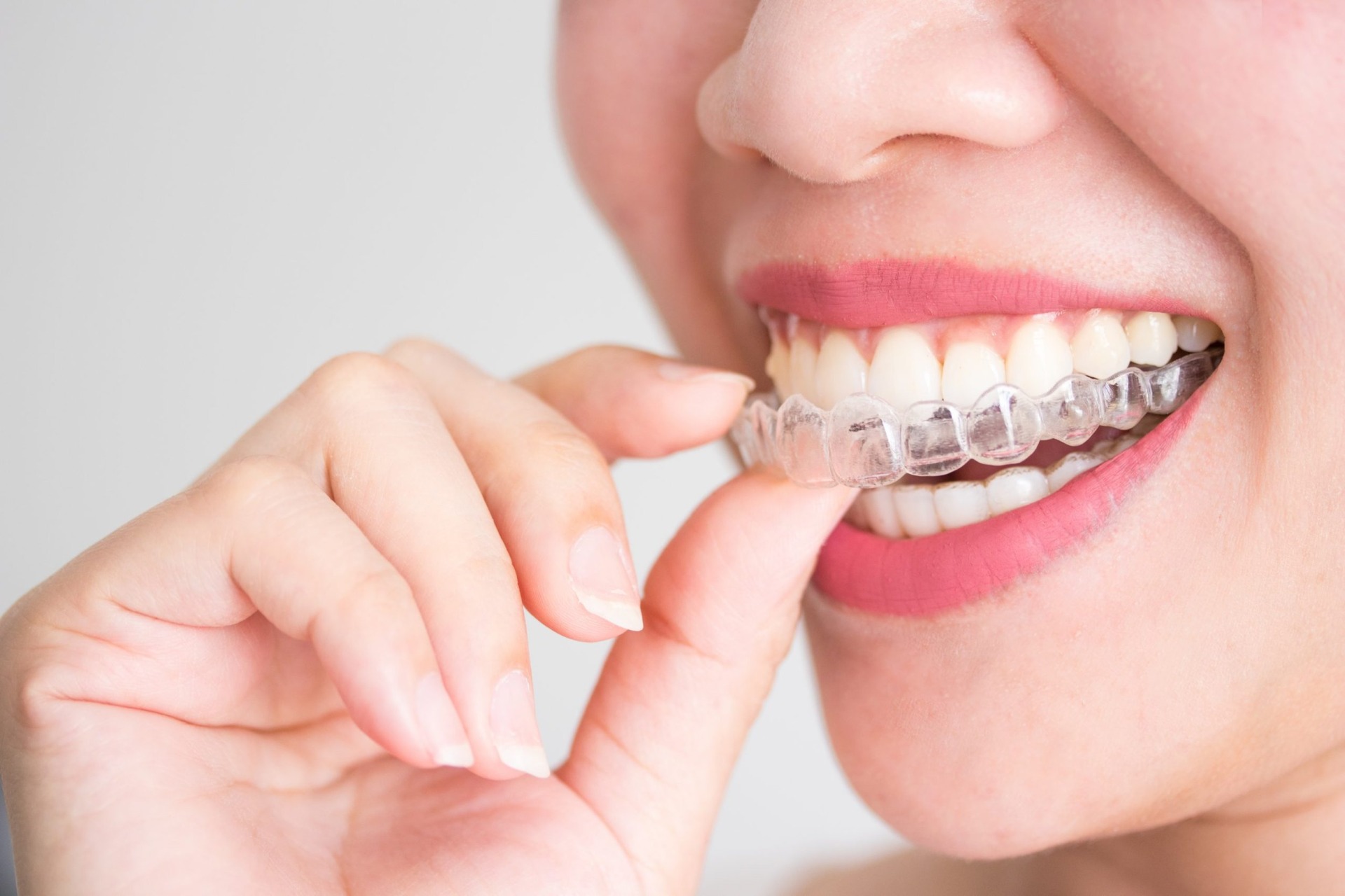 Niềng Răng Clear Aligner Trọn Gói Ở Gia Lâm: An Tâm Chi Phí