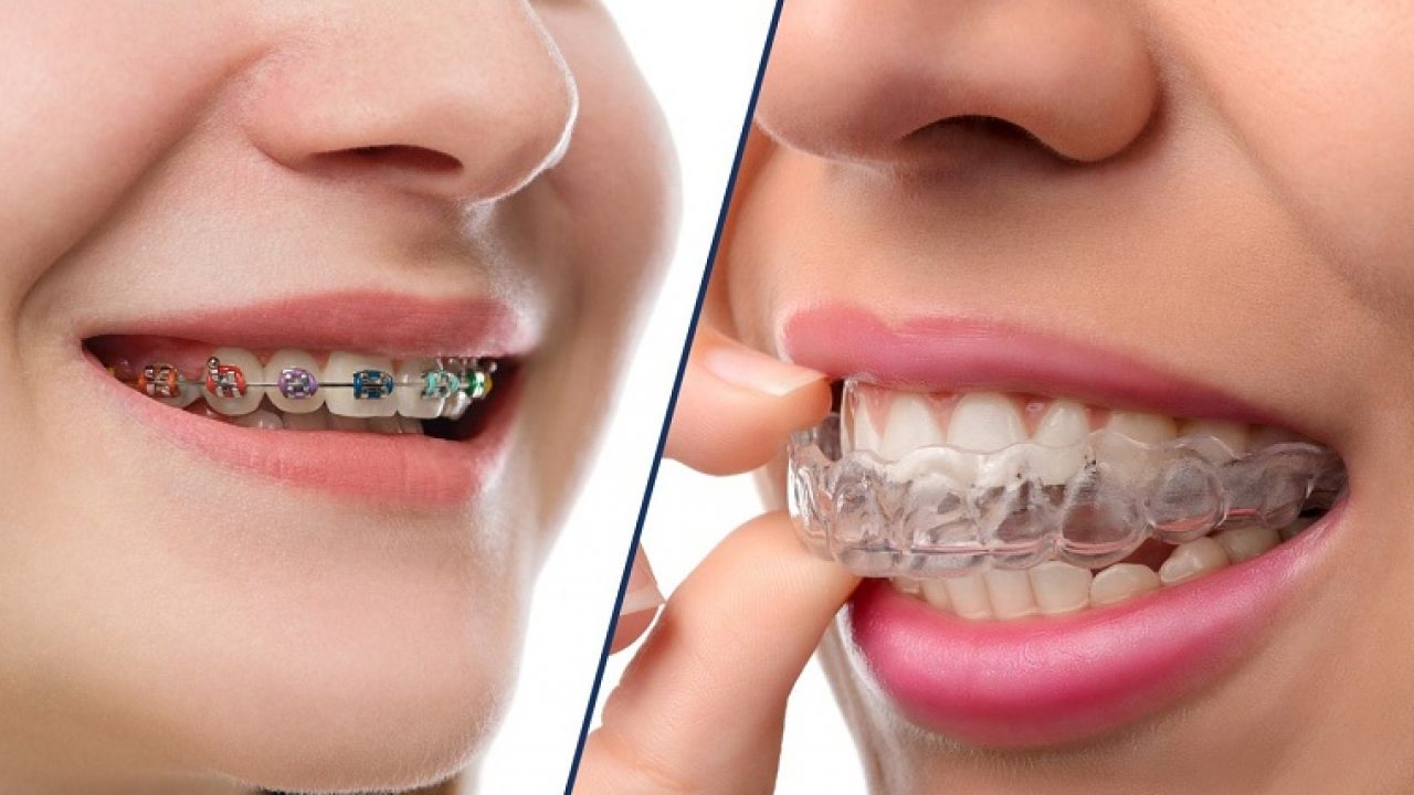 Niềng răng trong suốt trả góp ở Gia Lâm