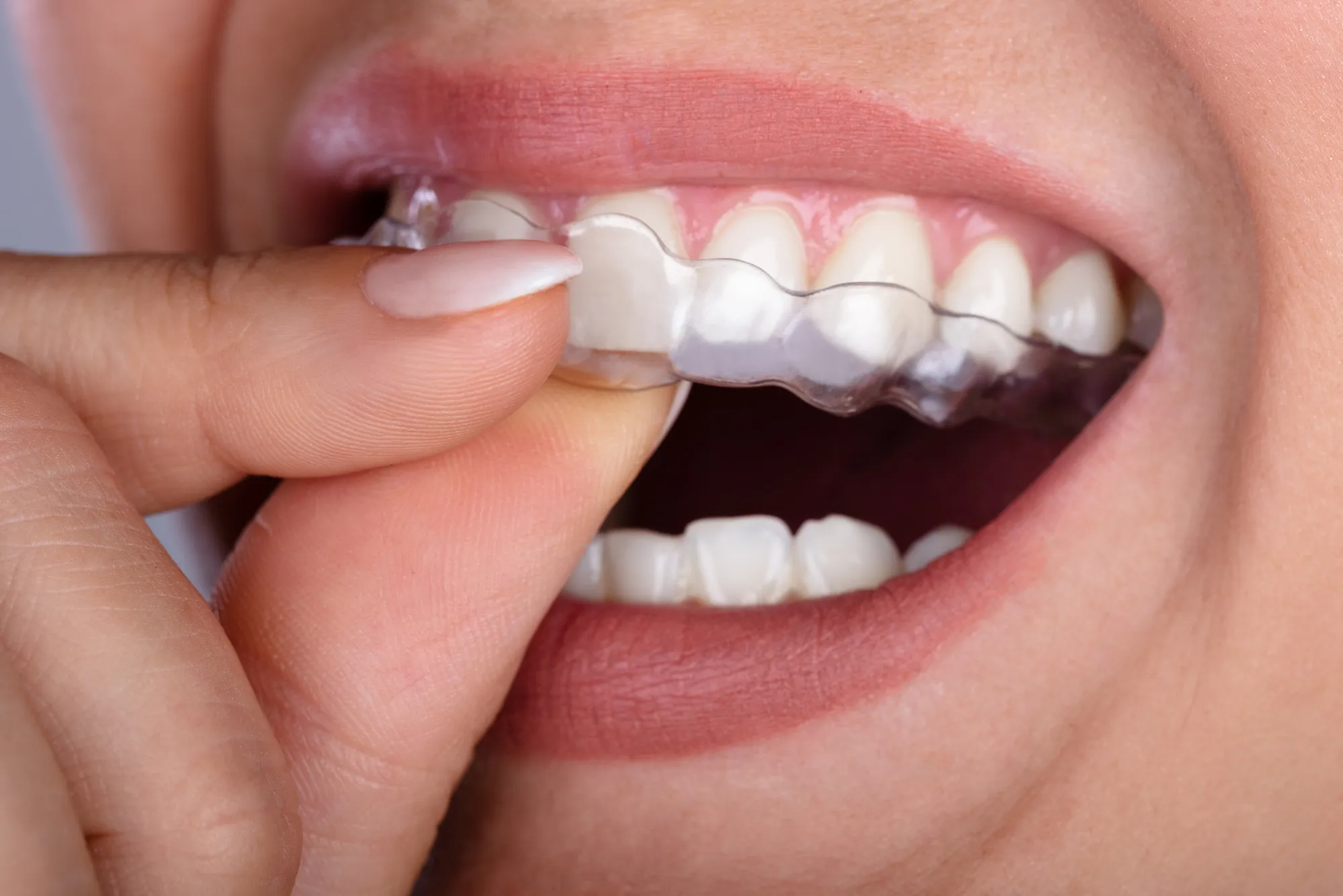 Bảng Giá Niềng Răng Clear Aligner Ở Gia Lâm: Chi Tiết Và Cập Nhật