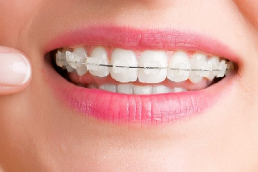 Niềng Răng Mắc Cài Trong Suốt Trả Góp Ở Gia Lâm: Giải Pháp Tài Chính Tối Ưu