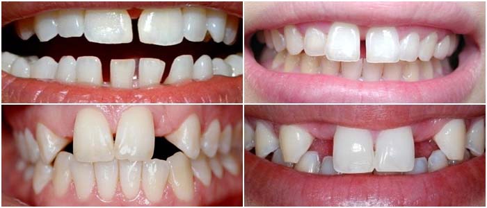 Niềng răng thưa 1 Niềng răng thưa 1