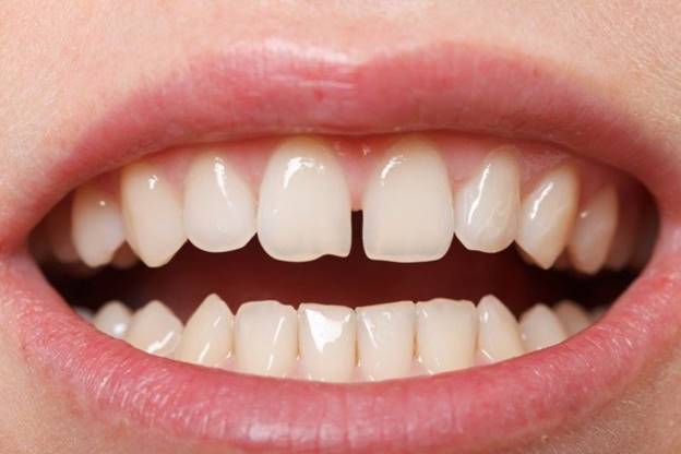 Niềng Răng Thưa Trả Góp Ở Gia Lâm: Giải Pháp Tài Chính Tối Ưu