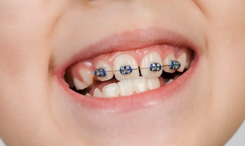 Niềng Răng Thưa Giá Rẻ Ở Gia Lâm: Cân Nhắc Thông Minh Để Có Nụ Cười Đẹp