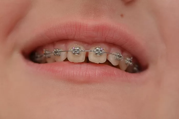Niềng Răng Thưa Gần Đây Ở Gia Lâm: Tìm Kiếm Nhanh, Chọn Lựa Đúng