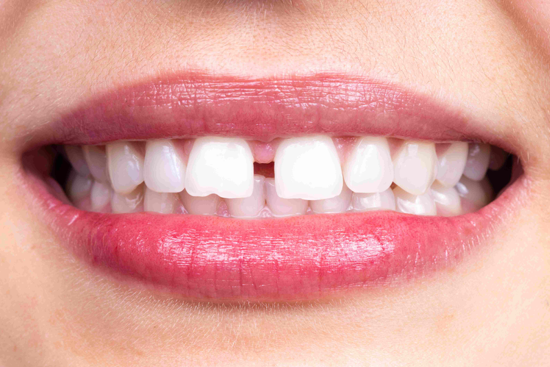 Địa Chỉ Nha Khoa Niềng Răng Thưa Ở Gia Lâm: Tìm Kiếm và Lựa Chọn