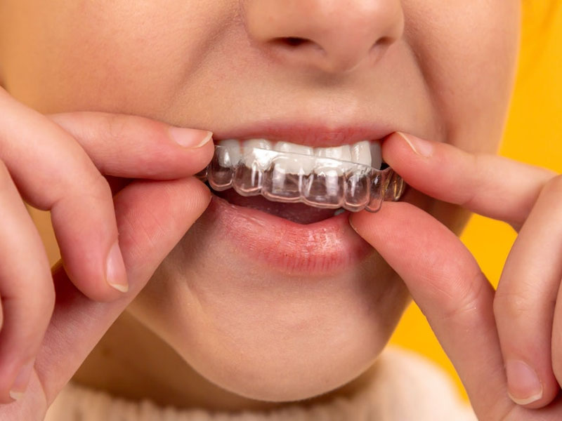 Niềng Răng Trong Suốt Clear Aligner Ở Gia Lâm: Giải Pháp Chỉnh Nha Hiện Đại