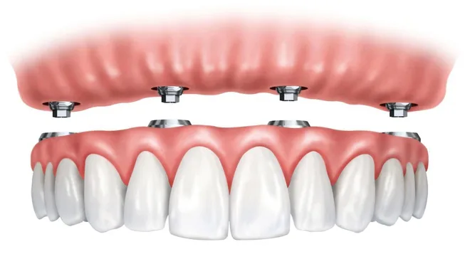 Làm Răng Implant: Giải Pháp Phục Hình Răng Mất Hiện Đại, Thẩm Mỹ và Bền Vững