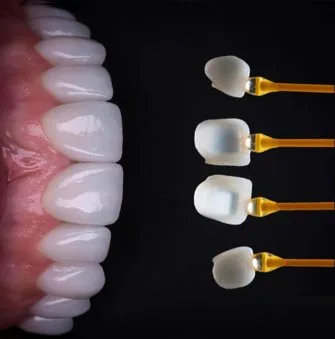 veneer-.jpg