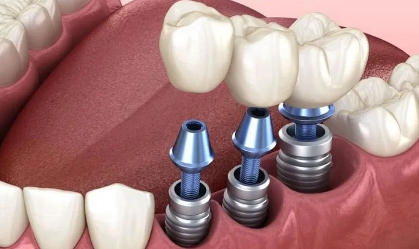 Cay-ghep-Implant.jpg Cay-ghep-Implant.jpg