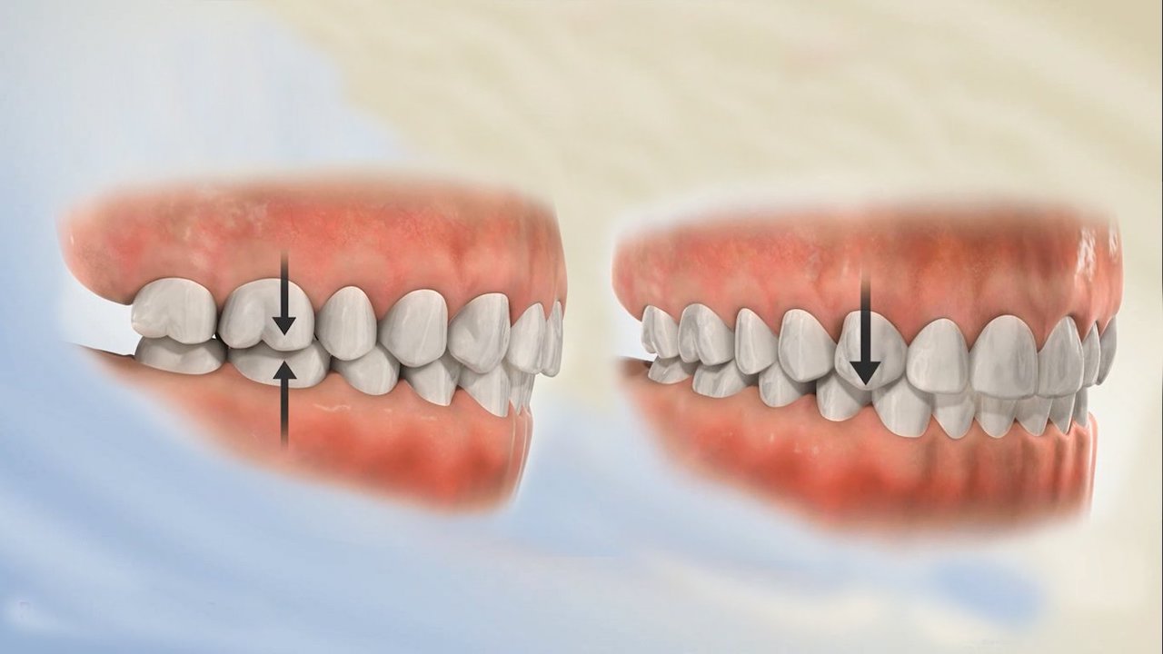 Điều Trị Khớp Cắn Sâu Bằng Kỹ Thuật Đánh Lún Răng Cửa