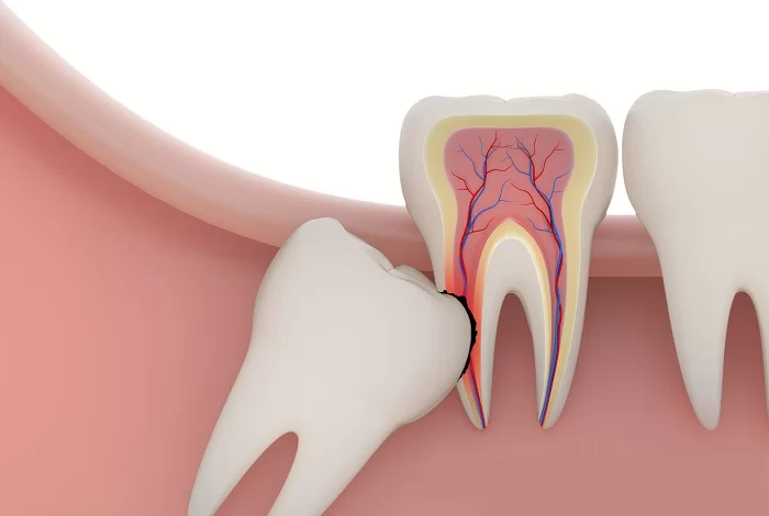 Phẫu Thuật Cắt Thân Răng Có Chủ Đích-1