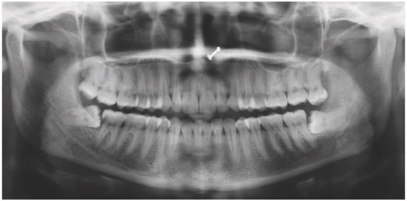 Phẫu Thuật Cắt Thân Răng Có Chủ Đích (Intentional Coronectomy)