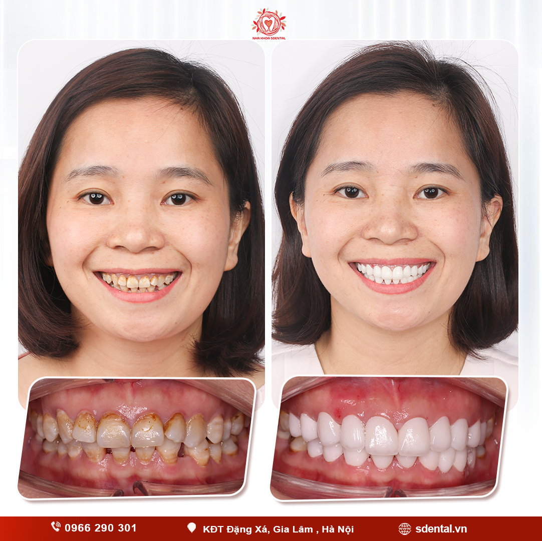 Nha khoa niềng răng thẩm mỹ ở Gia Lâm