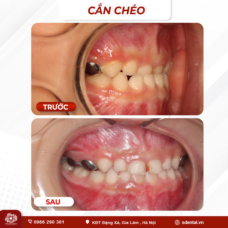 can-cheo-033