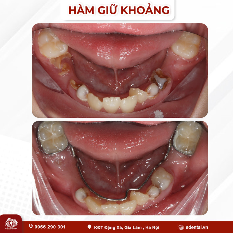 ham-giu-khoang-2