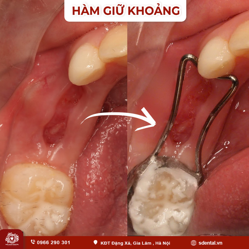 ham-giu-khoang-3-1