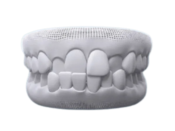 Răng khấp khểnh, chen chúc